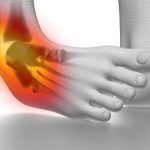 Acute peesruptuur tibialis posterior komt vaker voor dan gedacht